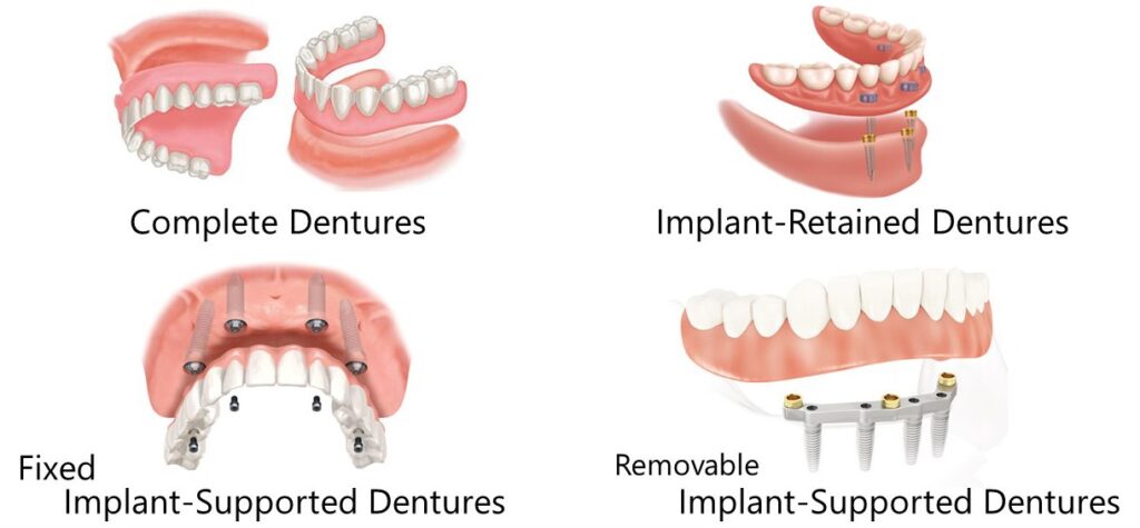 dental implants and dentures in hawthorn east
