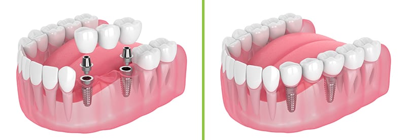 Dental implant bridges