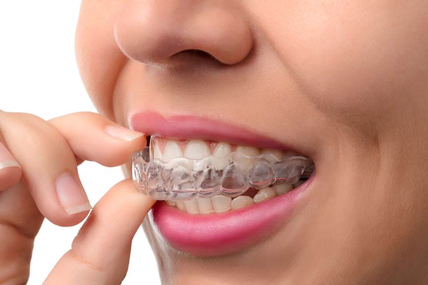 10 Crucial Aspects of Your Invisalign Teeth Straightening Procedure